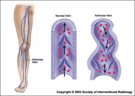 varicose_vein_with_leg.gif